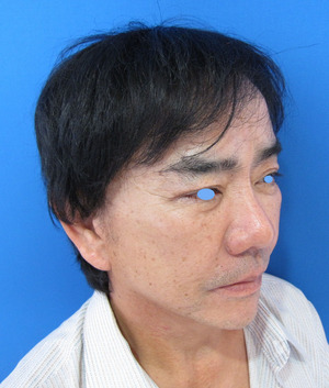 目の下のたるみ、目のくまでお悩みの方、切らずに完璧に解決します。TCB-R法　手術直後　症例写真